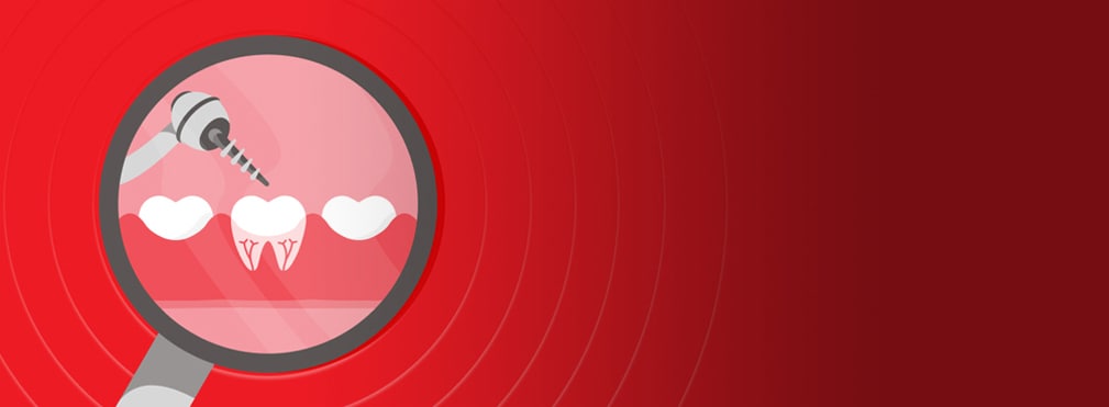 שיניים שנקדחות