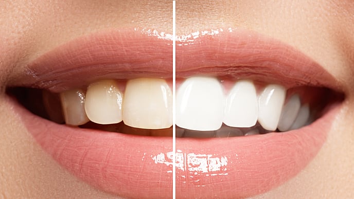 חיוך עם שיניים לפני ואחרי הלבנת שיניים